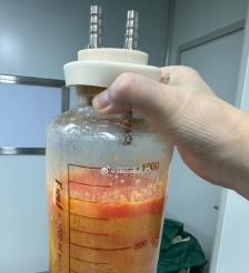 邢台水动力吸脂手术要做多久？